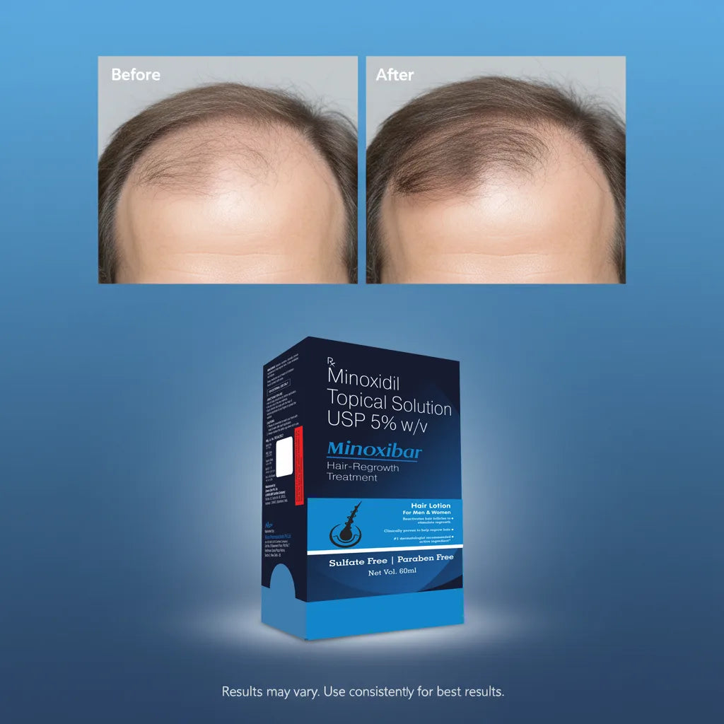 minoxibar hair lotion